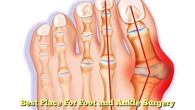 Best Place For Foot and Ankle Surgery