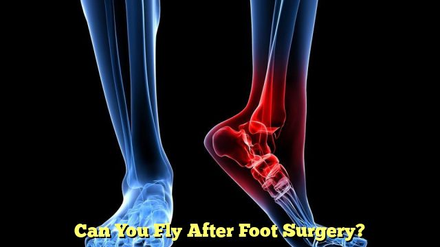 Can You Fly After Foot Surgery?