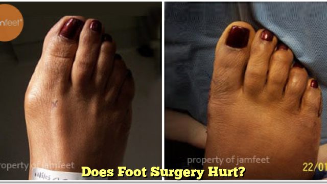 Does Foot Surgery Hurt?