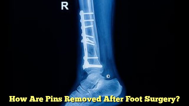 How Are Pins Removed After Foot Surgery?