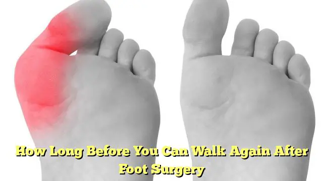 How Long Before You Can Walk Again After Foot Surgery