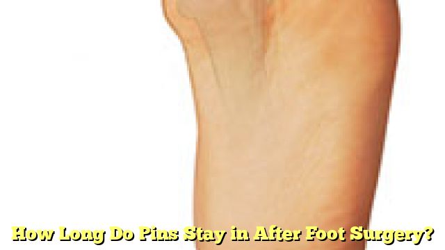 How Long Do Pins Stay in After Foot Surgery?