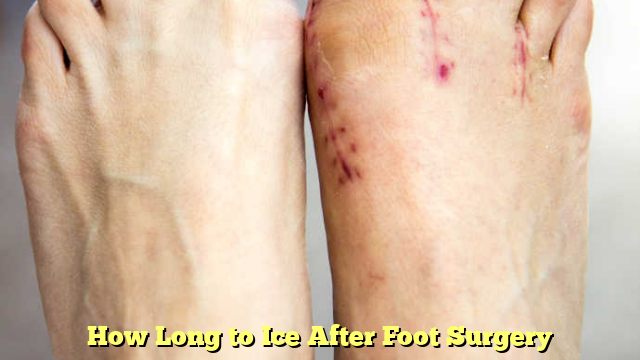 How Long to Ice After Foot Surgery