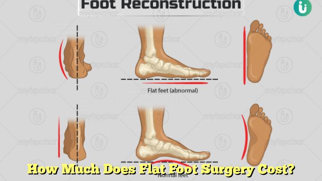 How Much Does Flat Foot Surgery Cost?